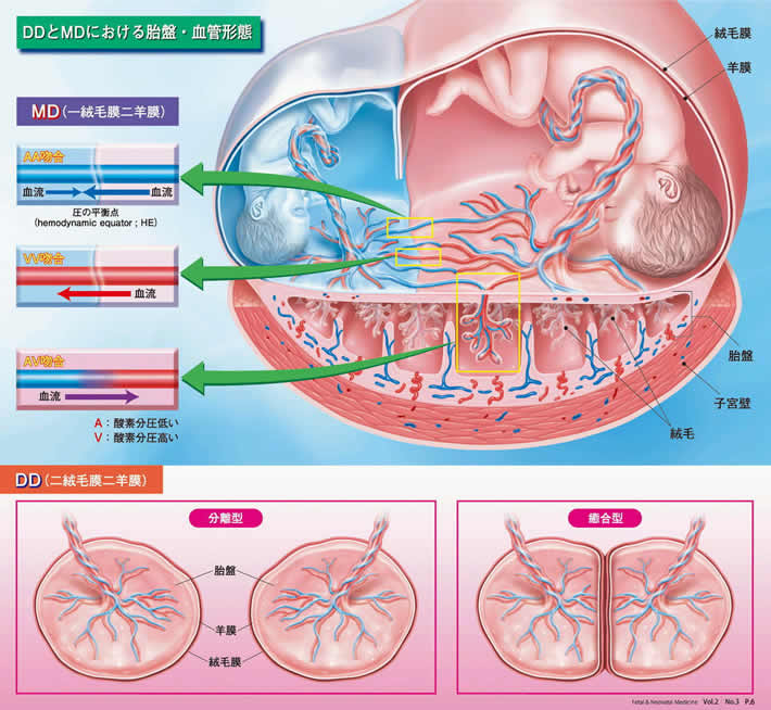 DDとMDにおける胎盤・血管形態