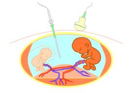 胎児鏡下胎盤吻合血管レーザー凝固術（FLP）