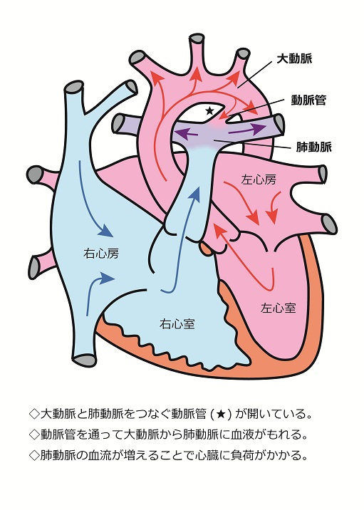 動脈管開存症 宮城県立こども病院 Miyagi Children S Hospital