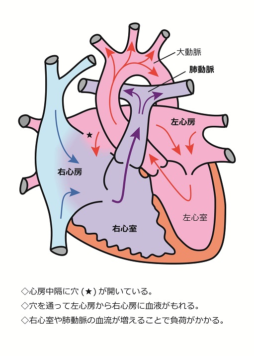 心房中隔欠損症6