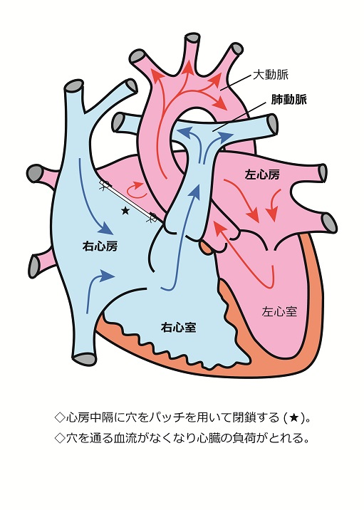 心房中隔欠損症7