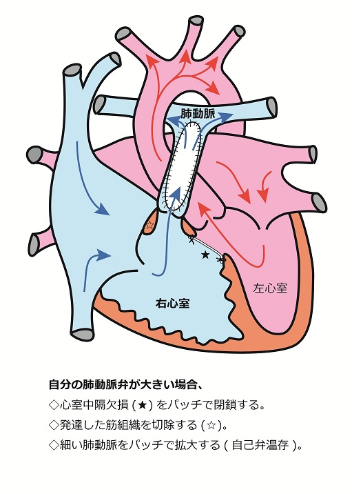 心臓シェーマ