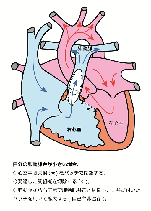 心臓シェーマ